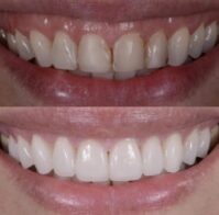 cosmetic dentist in bellevue